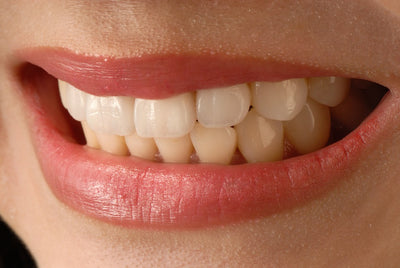 Will Teeth Whitening Work On Veneers?