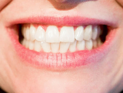 Will Teeth Whitening Remove Stains